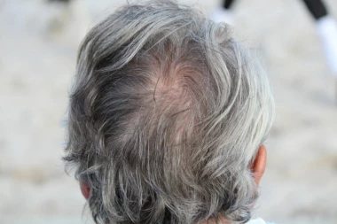 (RECEPT) Prirodni melem protiv ćelavosti stimuliše rast kose i obnavlja oštećene vlasi