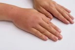 VIDLJIVI SIMPTOM VISOKOG PRITISKA: Ako primetite ove promene na prstima, odmah idite kod lekara!